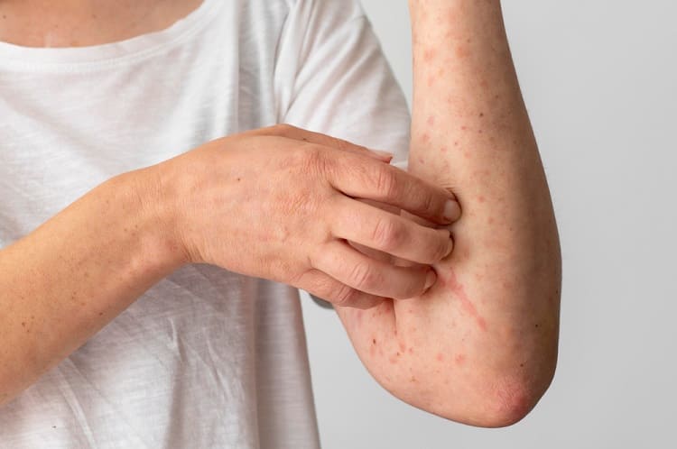 Domače Zdravilo za Seboroični Dermatitis